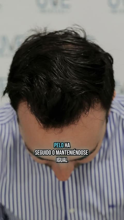 Reel de UVE Medical sobre la pérdida de densidad del cabello