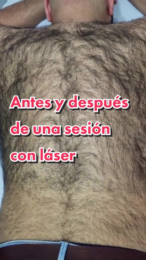 Vídeo de TikTok de ST Láser: antes y después de una sesión de láser